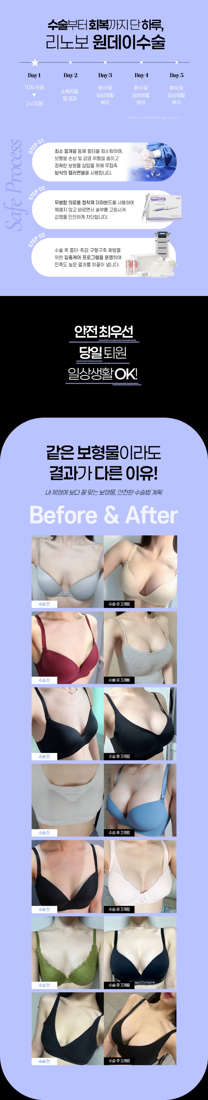 강남언니_가슴성형이벤트_260526_02.jpg