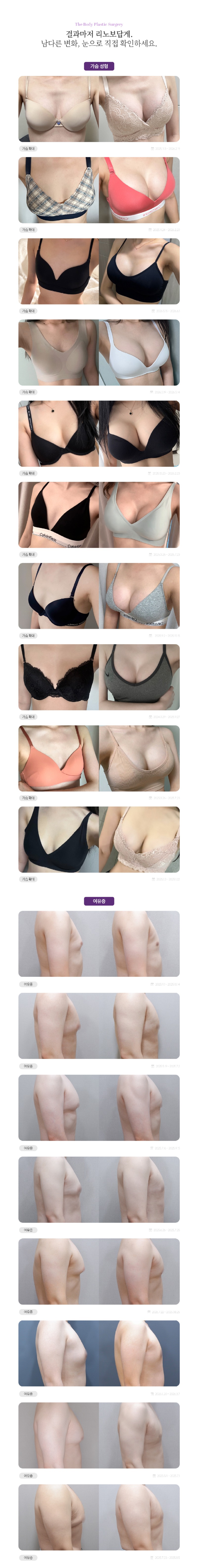 성형 시술 전후1.jpg