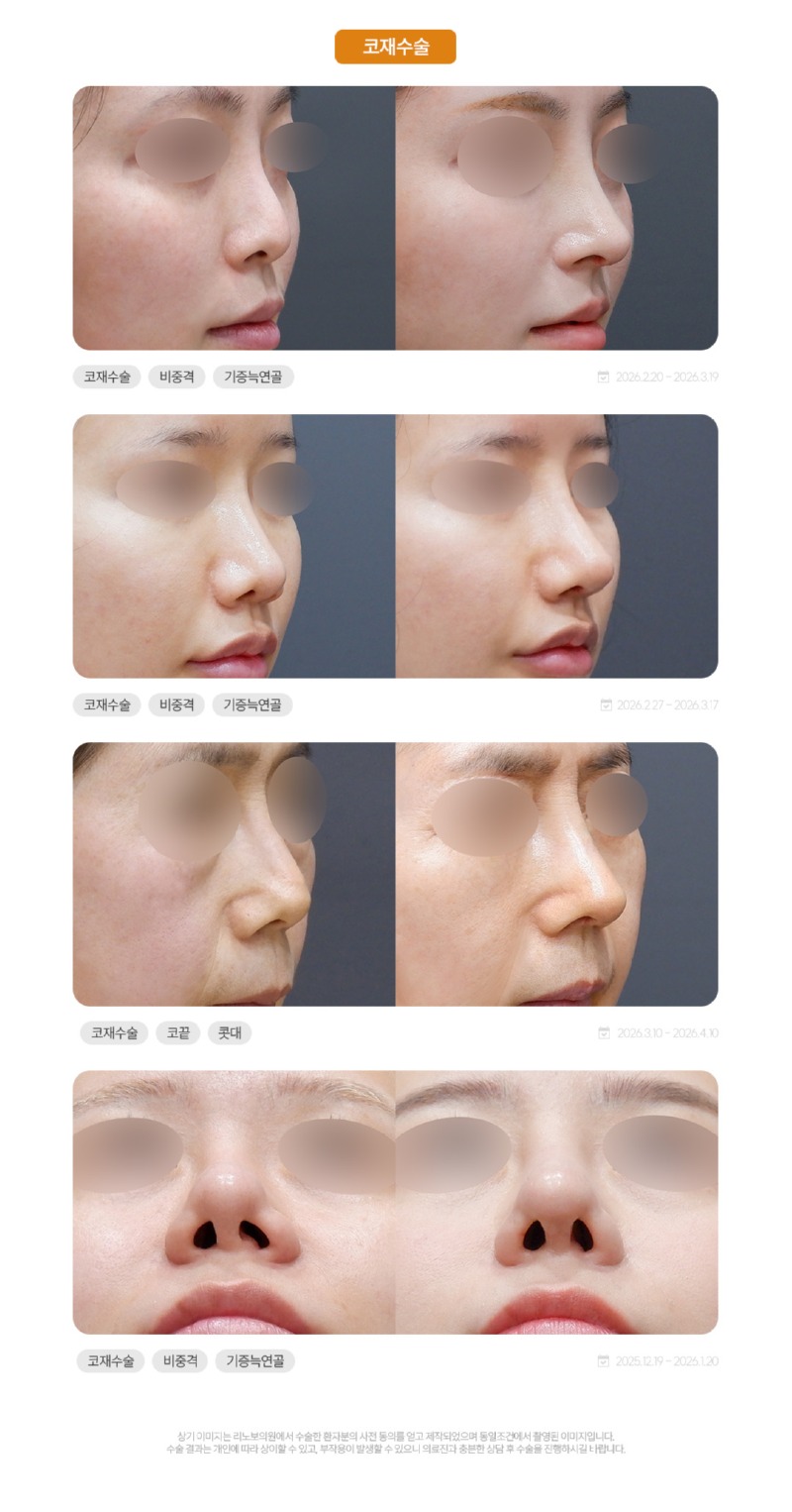성형 시술(페이스) 전후2.jpg