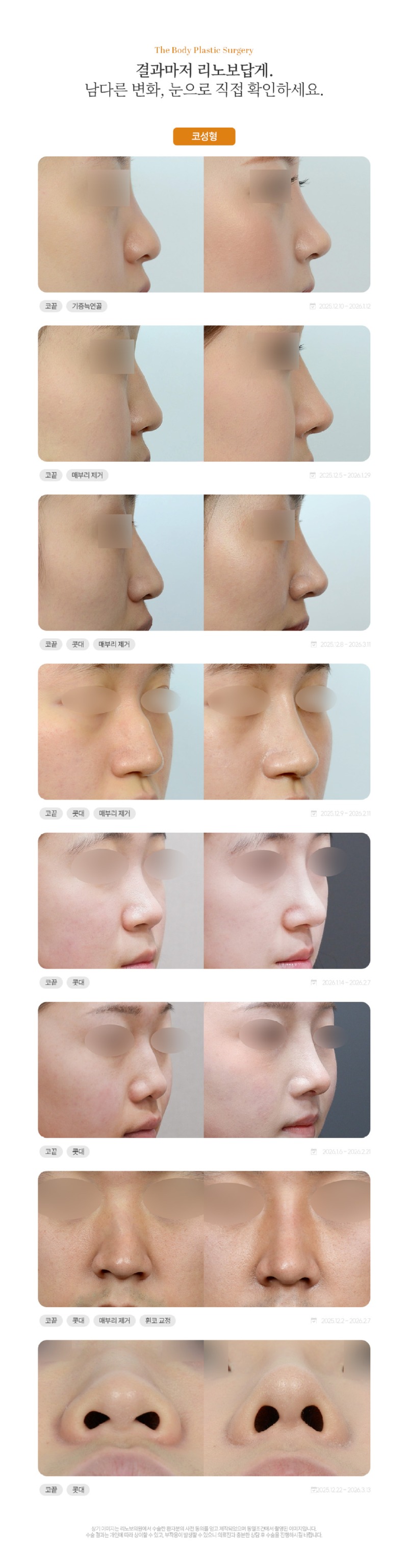 성형 시술(페이스) 전후1.jpg