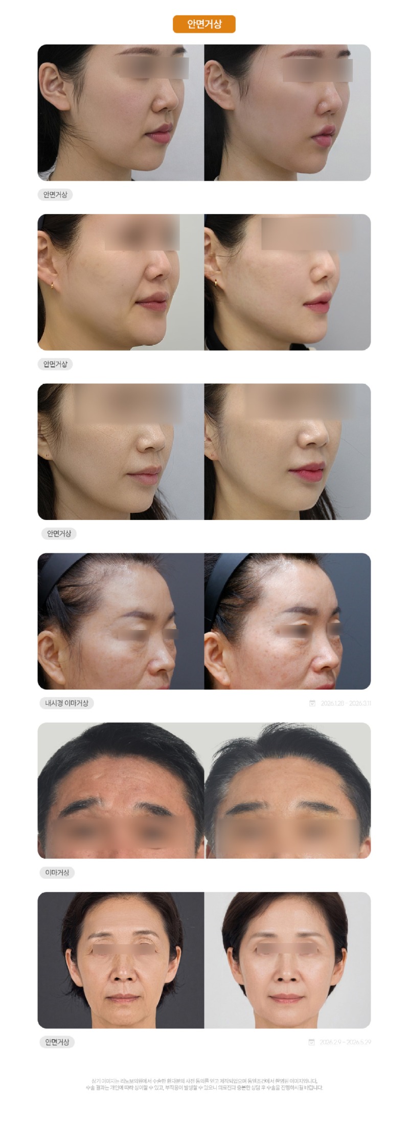 성형 시술(페이스) 전후4.jpg