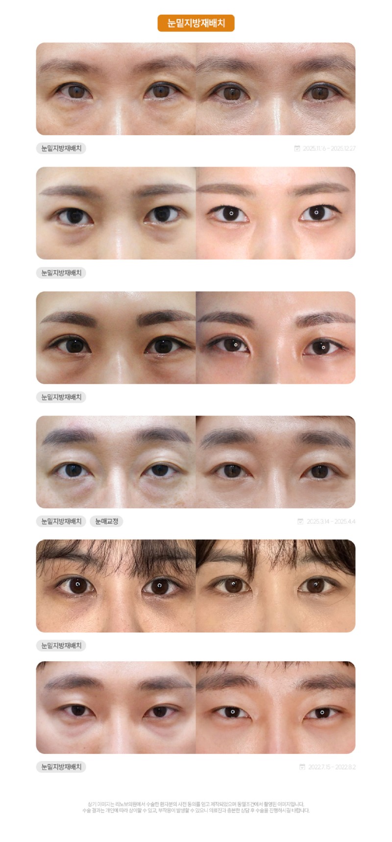 성형 시술(페이스) 전후3.jpg