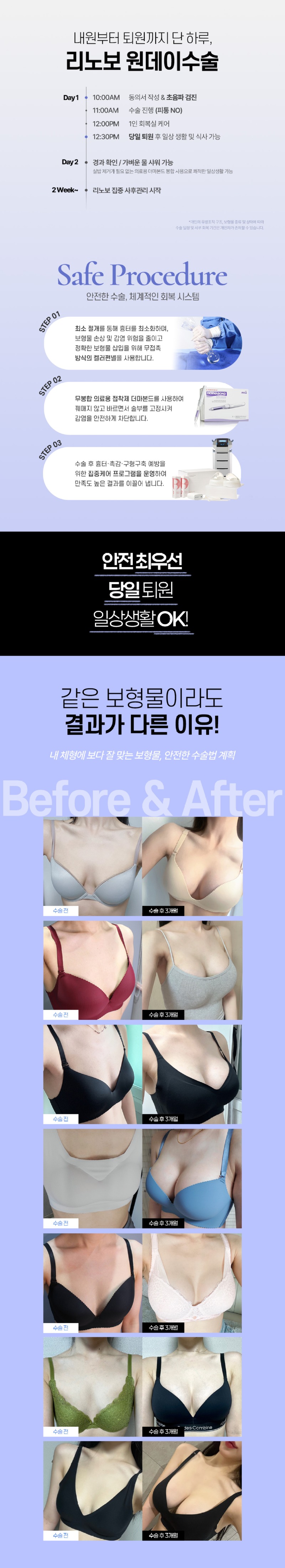 홈페이지_가슴성형이벤트_260730_02.jpg